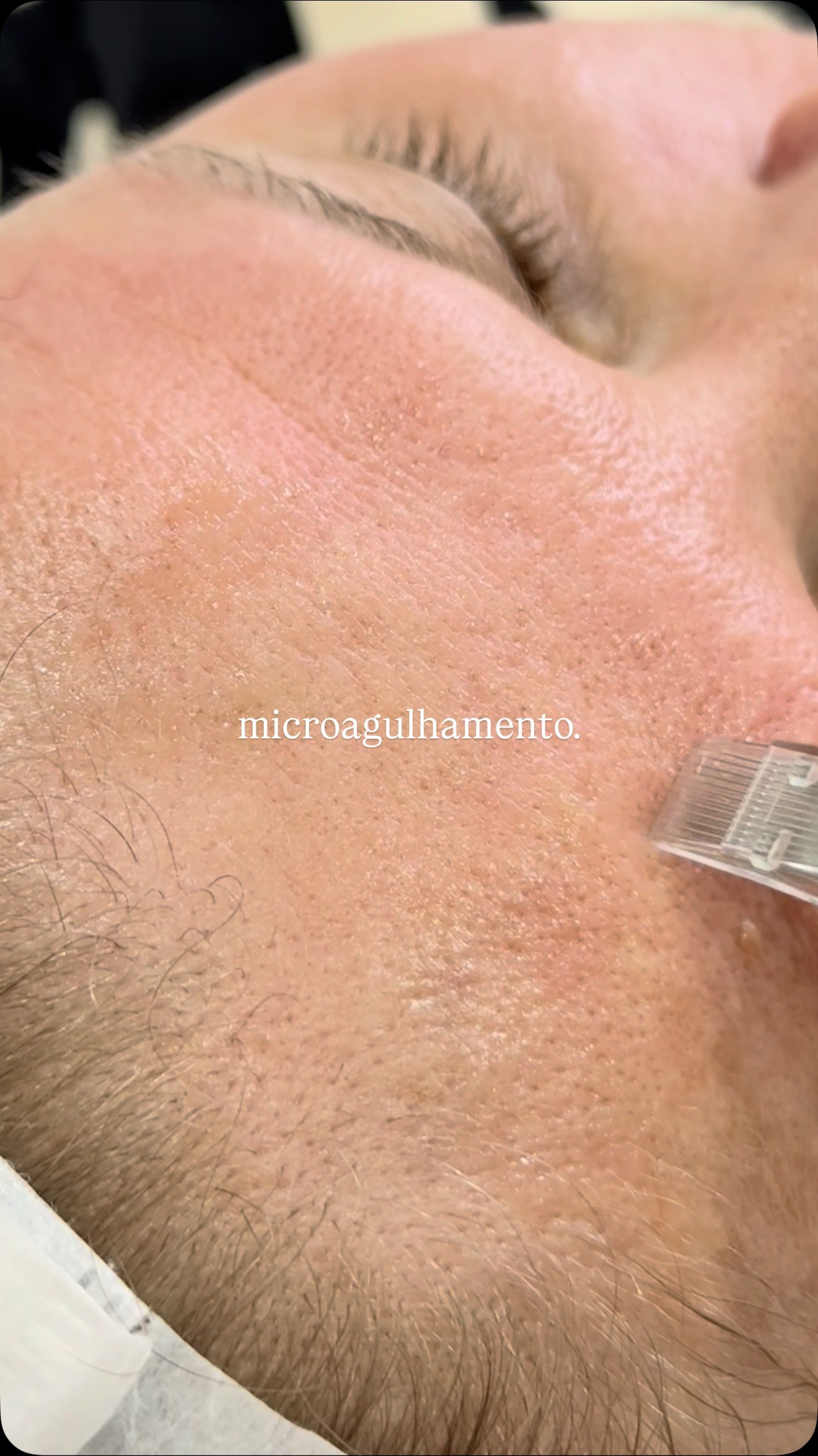 Microagulhamento