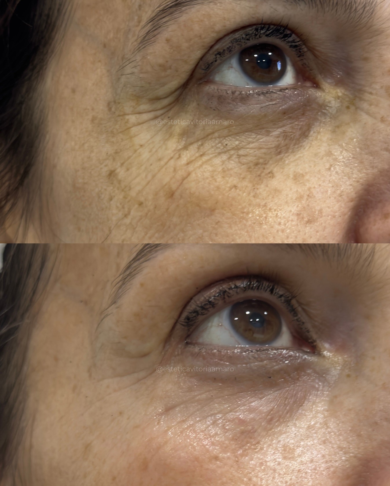 Jato de plasma na área dos olhos
